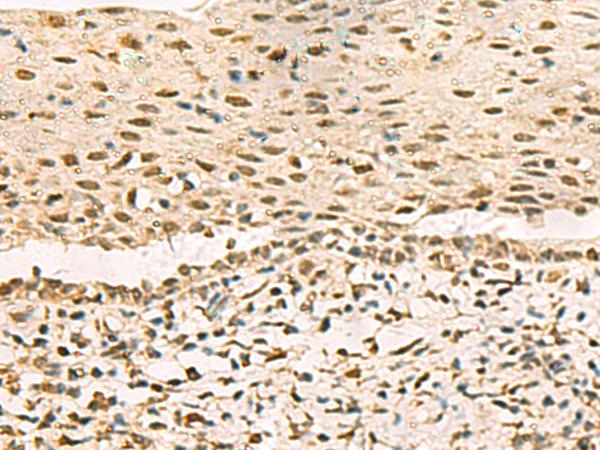 GRWD1 Antibody - Immunohistochemistry of paraffin-embedded Human cervical cancer tissue  using GRWD1 Polyclonal Antibody at dilution of 1:90(×200)
