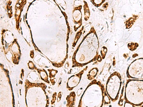 GRWD1 Antibody - Immunohistochemistry of paraffin-embedded Human thyroid cancer tissue  using GRWD1 Polyclonal Antibody at dilution of 1:55(×200)
