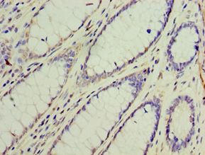 GS28 / GOSR1 / p28 Antibody - Immunohistochemistry of paraffin-embedded human colon cancer using antibody at 1:100 dilution.