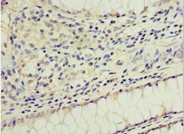 GS28 / GOSR1 / p28 Antibody - Immunohistochemistry of paraffin-embedded human colon cancer using antibody at 1:100 dilution.