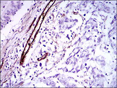 GSC / Goosecoid Antibody - IHC of paraffin-embedded colon cancer tissues using GSC mouse monoclonal antibody with DAB staining.