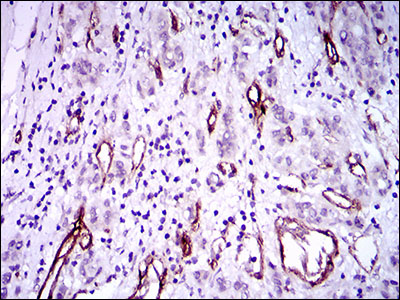 GSC / Goosecoid Antibody - IHC of paraffin-embedded liver cancer tissues using GSC mouse monoclonal antibody with DAB staining.