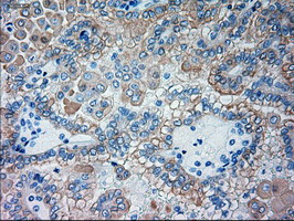 GSC / Goosecoid Antibody - IHC of paraffin-embedded Carcinoma of Human kidney tissue using anti-GSC mouse monoclonal antibody.