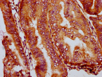 GSDMA Antibody - Immunohistochemistry Dilution at 1:400 and staining in paraffin-embedded human endometrial cancer performed on a Leica BondTM system. After dewaxing and hydration, antigen retrieval was mediated by high pressure in a citrate buffer (pH 6.0). Section was blocked with 10% normal Goat serum 30min at RT. Then primary antibody (1% BSA) was incubated at 4°C overnight. The primary is detected by a biotinylated Secondary antibody and visualized using an HRP conjugated SP system.