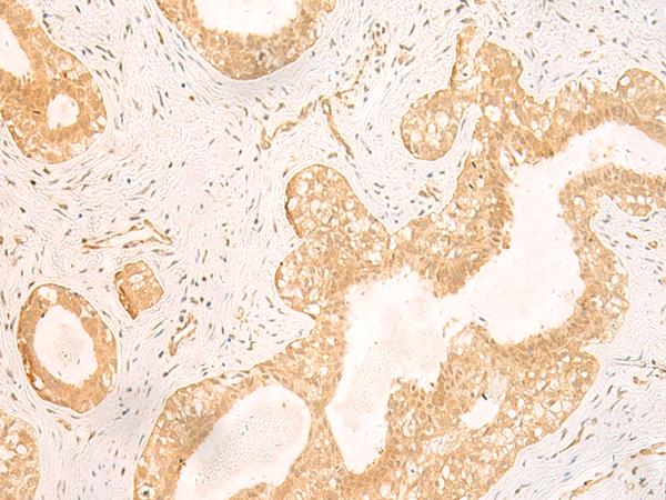GSG1L Antibody - Immunohistochemistry of paraffin-embedded Human breast cancer tissue  using GSG1L Polyclonal Antibody at dilution of 1:50(×200)