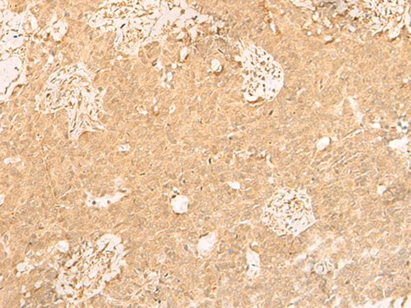 GSG1L Antibody - Immunohistochemistry of paraffin-embedded Human ovarian cancer tissue  using GSG1L Polyclonal Antibody at dilution of 1:50(×200)