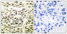 GSK3 Alpha+Beta Antibody - Immunohistochemistry analysis of paraffin-embedded human breast carcinoma tissue, using GSK3 alpha/beta Antibody. The picture on the right is blocked with the synthesized peptide.
