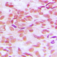 GSK3 Alpha+Beta Antibody - Immunohistochemical analysis of GSK3 alpha/beta staining in human breast cancer formalin fixed paraffin embedded tissue section. The section was pre-treated using heat mediated antigen retrieval with sodium citrate buffer (pH 6.0). The section was then incubated with the antibody at room temperature and detected using an HRP conjugated compact polymer system. DAB was used as the chromogen. The section was then counterstained with hematoxylin and mounted with DPX.