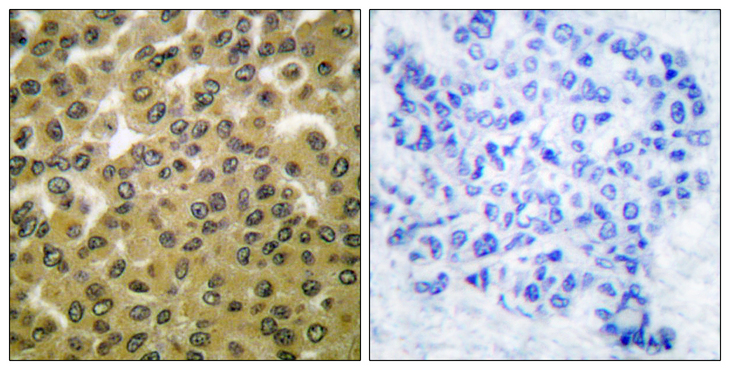 GSK3 Alpha+Beta Antibody - Immunohistochemistry analysis of paraffin-embedded human breast carcinoma, using GSK3 alpha/beta (Phospho-Tyr279/216) Antibody. The picture on the right is blocked with the phospho peptide.