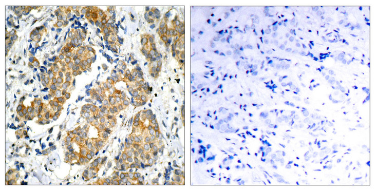 GSK3A / GSK3 Alpha Antibody - Immunohistochemistry analysis of paraffin-embedded human breast carcinoma, using GSK3 alpha Antibody. The picture on the right is blocked with the synthesized peptide.
