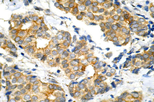 GSK3A / GSK3 Alpha Antibody - IHC of GSK3 (G15)pAb in paraffin-embedded human breast carcinoma tissue.