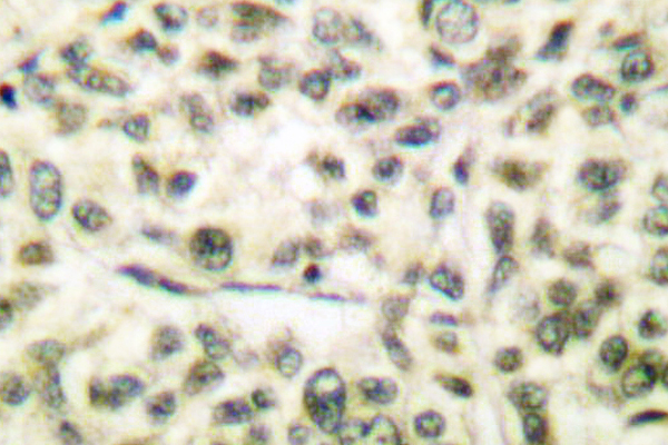 GSK3A / GSK3 Alpha Antibody - IHC of GSK3/ (G273) pAb in paraffin-embedded human breast carcinoma tissue.