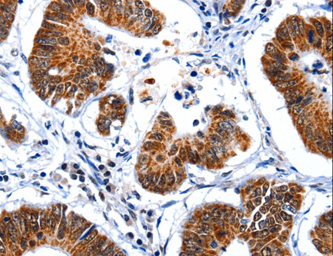 GSK3A / GSK3 Alpha Antibody - Immunohistochemistry of paraffin-embedded Human ovarian cancer using GSK3A Polyclonal Antibody at dilution of 1:50.
