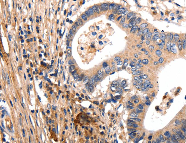 GSK3A / GSK3 Alpha Antibody - Immunohistochemistry of paraffin-embedded Human renal cancer using GSK3A Polyclonal Antibody at dilution of 1:50.