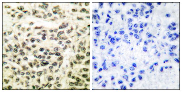 GSK3A / GSK3 Alpha Antibody - Peptide - + Immunohistochemical analysis of paraffin-embedded human breast carcinoma tissue using GSK3a/ß (Ab-279/216) antibody.