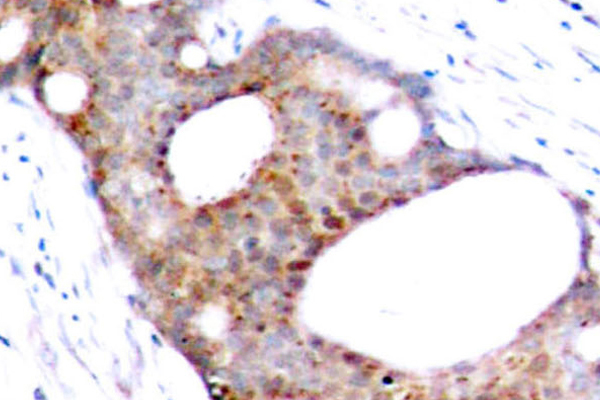 GSK3A / GSK3 Alpha Antibody - IHC of p-GSK3 (S21) pAb in paraffin-embedded human breast carcinoma tissue.