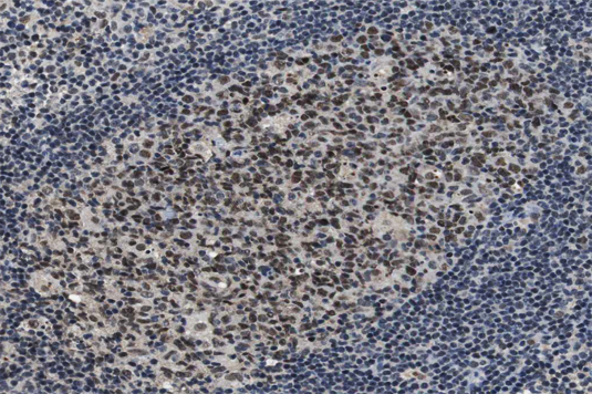 GSK3A / GSK3 Alpha Antibody - 1:100 staining human lymphoma tissue by IHC-P. The tissue was formaldehyde fixed and a heat mediated antigen retrieval step in citrate buffer was performed. The tissue was then blocked and incubated with the antibody for 1.5 hours at 22°C. An HRP conjugated goat anti-rabbit antibody was used as the secondary.