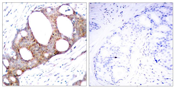 GSK3A / GSK3 Alpha Antibody - Immunohistochemical analysis of paraffin- embedded breast carcinoma. Left: Using GSK3a (Phospho-Ser21) Antibody; Right: The same antibody preincubated with synthesized phosphopeptide.