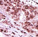 GSK3B / GSK3 Beta Antibody - Formalin-fixed and paraffin-embedded human cancer tissue reacted with the primary antibody, which was peroxidase-conjugated to the secondary antibody, followed by DAB staining. This data demonstrates the use of this antibody for immunohistochemistry; clinical relevance has not been evaluated. BC = breast carcinoma; HC = hepatocarcinoma.