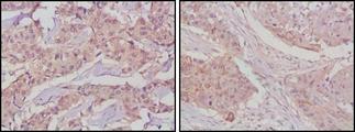 GSK3B / GSK3 Beta Antibody - Immunohistochemistry-Paraffin: GSK3 beta Antibody (3D10) - Immunohistochemical analysis of paraffin-embedded human lung cancer (left) and breast cancer tissues (right) using GSK3 beta mouse mAb with DAB staining.  This image was taken for the unconjugated form of this product. Other forms have not been tested.