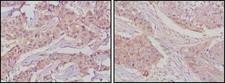 GSK3B / GSK3 Beta Antibody - Immunohistochemistry-Paraffin: GSK3 beta Antibody (3D10) - Immunohistochemical analysis of paraffin-embedded human lung cancer (left) and breast cancer tissues (right) using GSK3 beta mouse mAb with DAB staining.  This image was taken for the unconjugated form of this product. Other forms have not been tested.