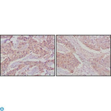 GSK3B / GSK3 Beta Antibody - Immunohistochemistry (IHC) analysis of paraffin-embedded human lung cancer (left) and breast cancer tissues (right) with DAB staining using GSK3beta Monoclonal Antibody.