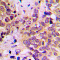 GSK3B / GSK3 Beta Antibody - Immunohistochemical analysis of GSK3 beta staining in human prostate cancer formalin fixed paraffin embedded tissue section. The section was pre-treated using heat mediated antigen retrieval with sodium citrate buffer (pH 6.0). The section was then incubated with the antibody at room temperature and detected using an HRP conjugated compact polymer system. DAB was used as the chromogen. The section was then counterstained with hematoxylin and mounted with DPX.