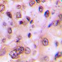 GSK3B / GSK3 Beta Antibody - Immunohistochemical analysis of GSK3 beta (pS9) staining in human breast cancer formalin fixed paraffin embedded tissue section. The section was pre-treated using heat mediated antigen retrieval with sodium citrate buffer (pH 6.0). The section was then incubated with the antibody at room temperature and detected using an HRP conjugated compact polymer system. DAB was used as the chromogen. The section was then counterstained with hematoxylin and mounted with DPX.
