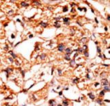 GSK3B / GSK3 Beta Antibody - Formalin-fixed and paraffin-embedded human cancer tissue reacted with the primary antibody, which was peroxidase-conjugated to the secondary antibody, followed by AEC staining. This data demonstrates the use of this antibody for immunohistochemistry; clinical relevance has not been evaluated. BC = breast carcinoma; HC = hepatocarcinoma.