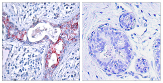GSK3B / GSK3 Beta Antibody - Immunohistochemistry analysis of paraffin-embedded human breast carcinoma, using GSK3 beta (Phospho-Ser9) Antibody. The picture on the right is blocked with the phospho peptide.
