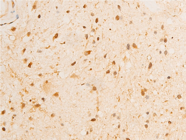 GSK3B / GSK3 Beta Antibody - 1:100 staining human glioma tissue by IHC-P. The tissue was formaldehyde fixed and a heat mediated antigen retrieval step in citrate buffer was performed. The tissue was then blocked and incubated with the antibody for 1.5 hours at 22°C. An HRP conjugated goat anti-rabbit antibody was used as the secondary.