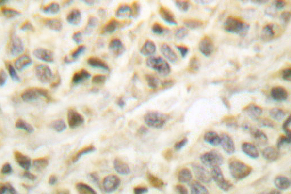 GSK3B / GSK3 Beta Antibody - IHC of GSK3 (S2) pAb in paraffin-embedded human breast carcinoma tissue.