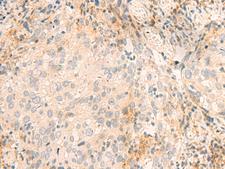 GSKIP / C14orf129 Antibody - Immunohistochemistry of paraffin-embedded Human cervical cancer tissue  using GSKIP Polyclonal Antibody at dilution of 1:45(×200)