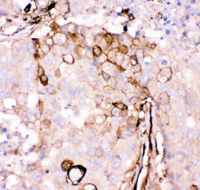 GSN / Gelsolin Antibody - Gelsolin antibody IHC-paraffin: Human Mammary Cancer Tissue.