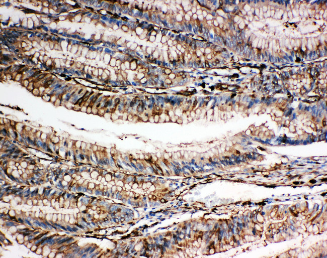 GSN / Gelsolin Antibody - GSN / Gelsolin antibody. IHC(P): Human Intestinal Cancer Tissue.