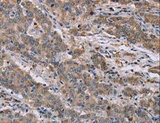GSN / Gelsolin Antibody - Immunohistochemistry of paraffin-embedded Human colon cancer using GSN Polyclonal Antibody at dilution of 1:40.