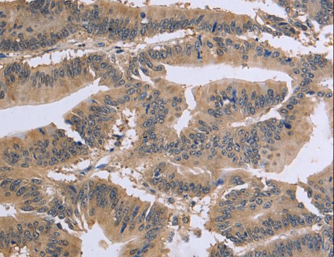 GSN / Gelsolin Antibody - Immunohistochemistry of paraffin-embedded Human colon cancer using GSN Polyclonal Antibody at dilution of 1:40.