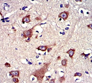 GSN / Gelsolin Antibody - IHC of paraffin-embedded human brain carcinoma tissue using GSN antibody.