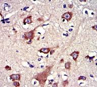 GSN / Gelsolin Antibody - IHC of paraffin-embedded human brain carcinoma tissue using GSN antibody.