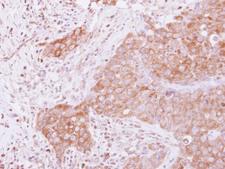GSPT1 Antibody - IHC of paraffin-embedded Breast ca, using GSPT1 antibody at 1:500 dilution.