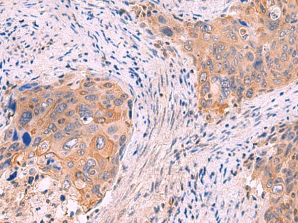GSPT2 Antibody - Immunohistochemistry of paraffin-embedded Human cervical cancer tissue  using GSPT2 Polyclonal Antibody at dilution of 1:50(×200)