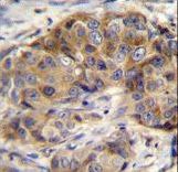GSR / Glutathione Reductase Antibody - GSR Antibody immunohistochemistry of formalin-fixed and paraffin-embedded human breast carcinoma followed by peroxidase-conjugated secondary antibody and DAB staining.