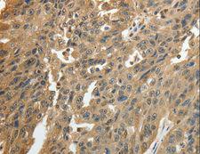 GSR / Glutathione Reductase Antibody - Immunohistochemistry of paraffin-embedded Human ovarian cancer using GSR Polyclonal Antibody at dilution of 1:50.