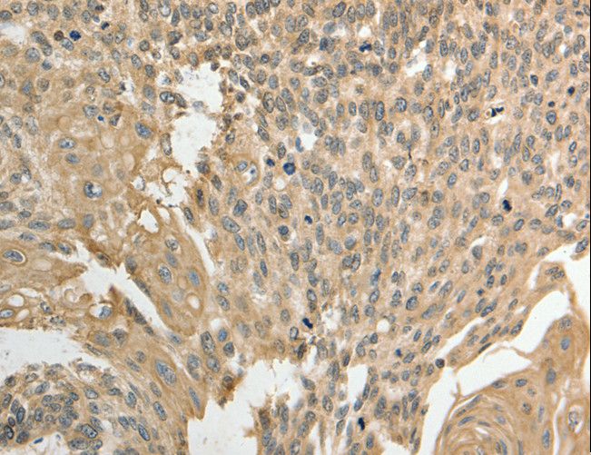 GSR / Glutathione Reductase Antibody - Immunohistochemistry of paraffin-embedded Human cervical cancer using GSR Polyclonal Antibody at dilution of 1:50.