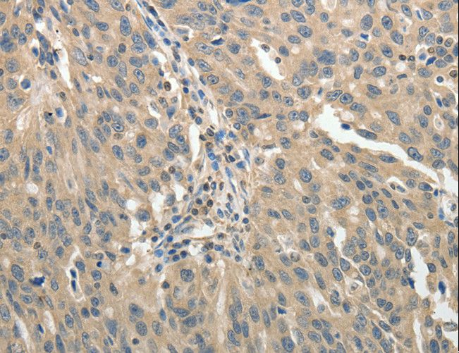 GSR / Glutathione Reductase Antibody - Immunohistochemistry of paraffin-embedded Human ovarian cancer using GSR Polyclonal Antibody at dilution of 1:50.