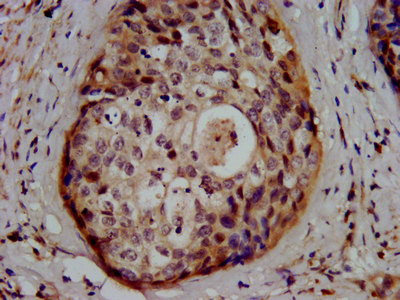 GSS / Glutathione Synthetase Antibody - Immunohistochemistry image at a dilution of 1:500 and staining in paraffin-embedded human cervical cancer performed on a Leica BondTM system. After dewaxing and hydration, antigen retrieval was mediated by high pressure in a citrate buffer (pH 6.0) . Section was blocked with 10% normal goat serum 30min at RT. Then primary antibody (1% BSA) was incubated at 4 °C overnight. The primary is detected by a biotinylated secondary antibody and visualized using an HRP conjugated SP system.