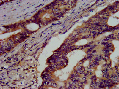 GSS / Glutathione Synthetase Antibody - Immunohistochemistry image at a dilution of 1:500 and staining in paraffin-embedded human colon cancer performed on a Leica BondTM system. After dewaxing and hydration, antigen retrieval was mediated by high pressure in a citrate buffer (pH 6.0) . Section was blocked with 10% normal goat serum 30min at RT. Then primary antibody (1% BSA) was incubated at 4 °C overnight. The primary is detected by a biotinylated secondary antibody and visualized using an HRP conjugated SP system.
