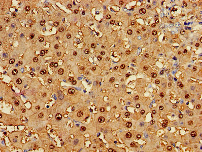 GSTA1 Antibody - Immunohistochemistry of paraffin-embedded human liver cancer using GSTA1 Antibody at dilution of 1:100