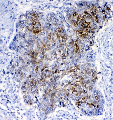 GSTA1+GSTA2+GSTA3+GSTA4+GSTA5 Antibody - IHC analysis of GSTA1/A2/A3/A4/A5 using anti-GSTA1/A2/A3/A4/A5 antibody. GSTA1/A2/A3/A4/A5 was detected in paraffin-embedded section of human lung cancer tissues. Heat mediated antigen retrieval was performed in citrate buffer (pH6, epitope retrieval solution) for 20 mins. The tissue section was blocked with 10% goat serum. The tissue section was then incubated with 1µg/ml rabbit anti-GSTA1/A2/A3/A4/A5 Antibody overnight at 4°C. Biotinylated goat anti-rabbit IgG was used as secondary antibody and incubated for 30 minutes at 37°C. The tissue section was developed using Strepavidin-Biotin-Complex (SABC) with DAB as the chromogen.