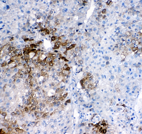 GSTA1+GSTA2+GSTA3+GSTA4+GSTA5 Antibody - IHC analysis of GSTA1/A2/A3/A4/A5 using anti-GSTA1/A2/A3/A4/A5 antibody. GSTA1/A2/A3/A4/A5 was detected in paraffin-embedded section of human liver cancer tissues. Heat mediated antigen retrieval was performed in citrate buffer (pH6, epitope retrieval solution) for 20 mins. The tissue section was blocked with 10% goat serum. The tissue section was then incubated with 1µg/ml rabbit anti-GSTA1/A2/A3/A4/A5 Antibody overnight at 4°C. Biotinylated goat anti-rabbit IgG was used as secondary antibody and incubated for 30 minutes at 37°C. The tissue section was developed using Strepavidin-Biotin-Complex (SABC) with DAB as the chromogen.